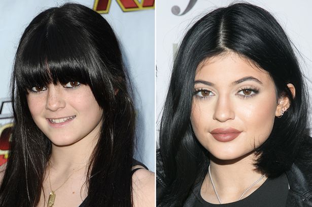 Kylie Jenner Before and After Big Lips