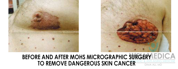Mohs Microgrpahic Surgery skin cancer awareness month patient at wellmedica reston va 