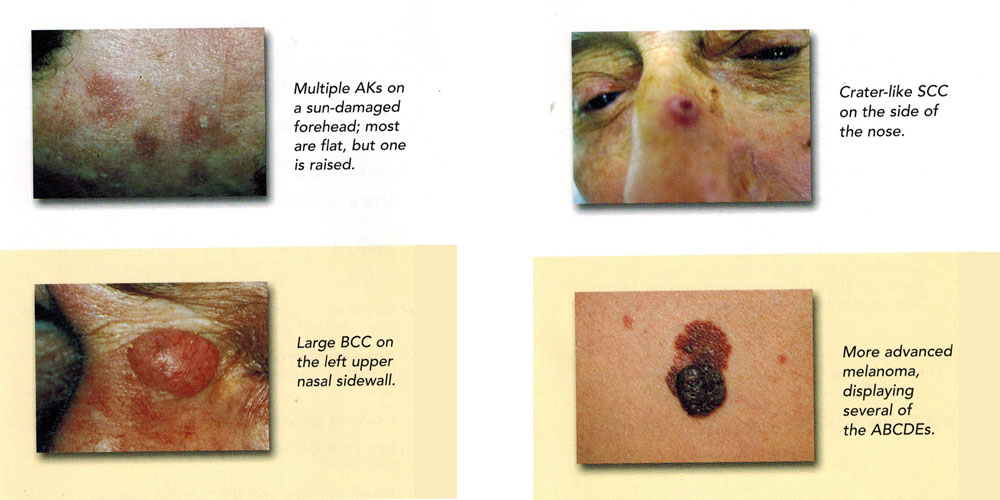 How to Prevent Skin Cancer Types Aks BBC SCC Melanoma 