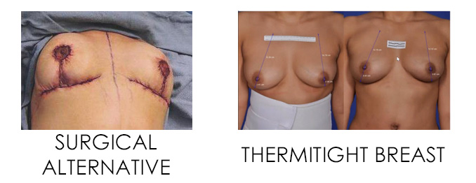 best non-surgical breast lift vs surgical breast lift 
