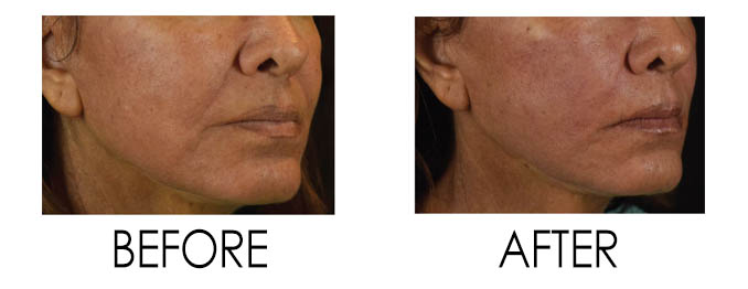 Tysons Non-Surgical Face lift Reston Before and After