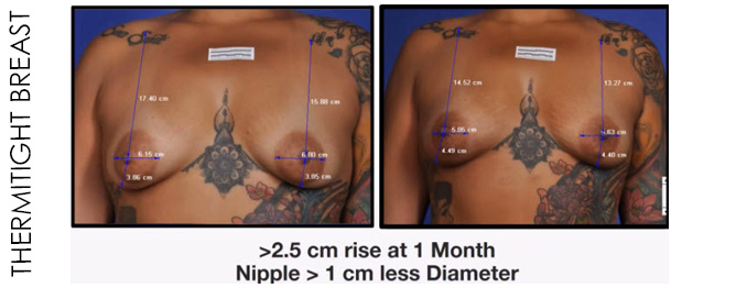 Non-Surgical Breast Lift for ThermiTight Breast Lollipop Lift Alternative Reston VA