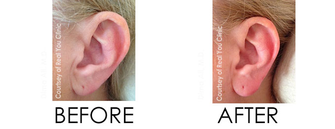 Ear Lobe Fillers Before and After