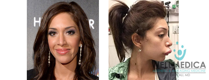 Farrah Abraham Lips Before and After Celebrity Lip Fillers Reston VA Dima Ali, MD