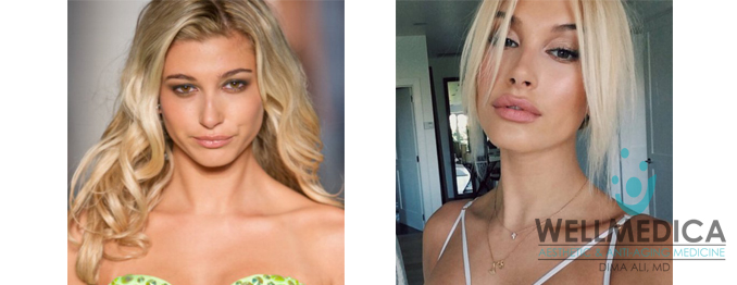 Hailey Baldwin Lips Before and After celebrity Lip fillers reston va dima ali md