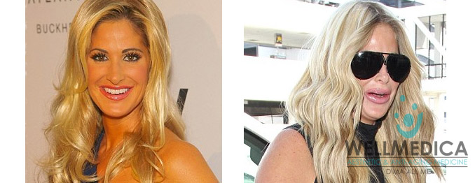 Kim Zolciak Lips Before and After celebrity lip fillers wellmedica reston va dima ali