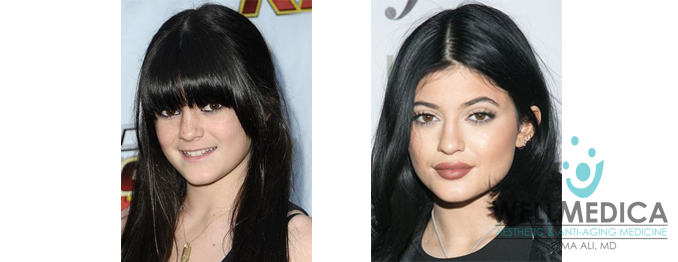Kylie Jenner Lips Before and After Celebrity Lip Fillers Reston VA Dima Ali