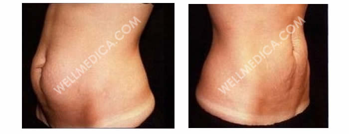 UltraShape-before-and-after