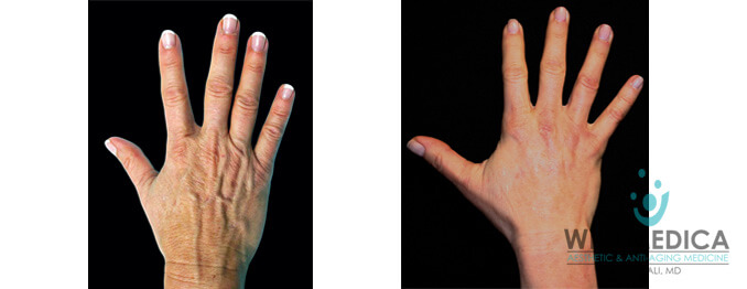 Before And After Hands Bellafill