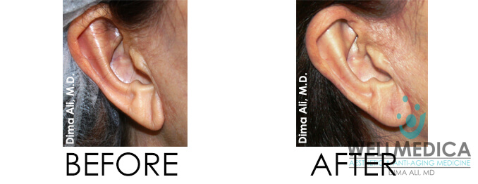 Ear Rejuvenation WellMedica Before And After Ear Lobes