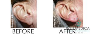 Earlobes rejuvenation before and after with filler treatment reston va 