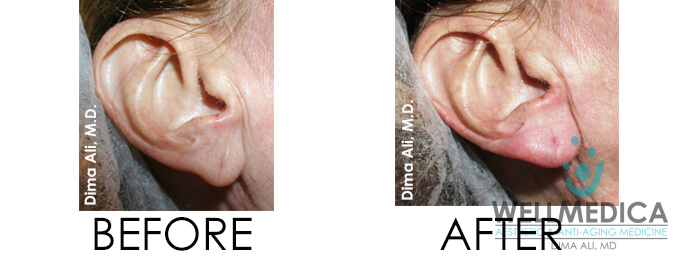 Earlobes Before And After Ear Filler Before And After