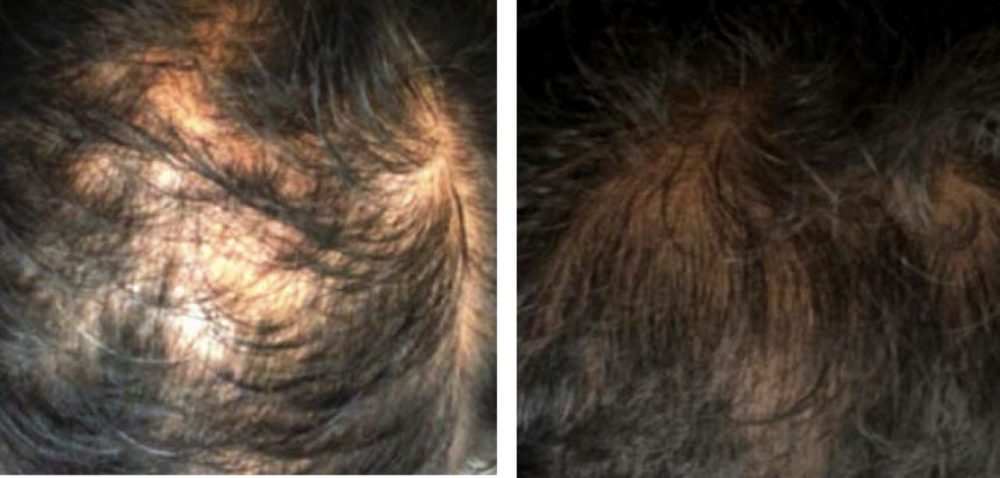 PRP for Hair Loss Treatment | Reston • Tysons • DC • Fairfax - Dr. Dima