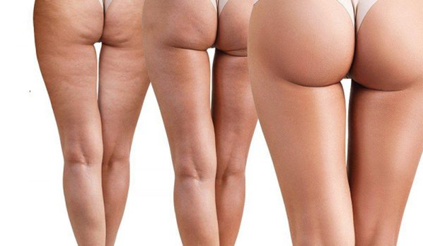 Juvly Aesthetics: Sculptra Body Contouring For Brazilian Butt Lift