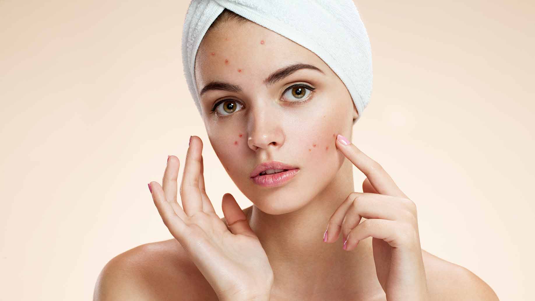 Reston Acne Treatment