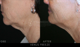 Venus Freeze - Face&Neck 3