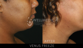 Venus Freeze - Face&Neck 2