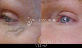 VBeam - Under Eye 2