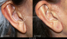 Filler-Ear 2