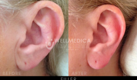 Filler-Ear 4