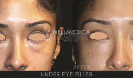 Filler-Under eye
