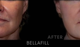 Bellafill 2