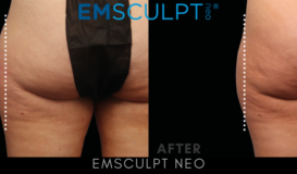 Emsculpt Neo - Outer Thigh 2