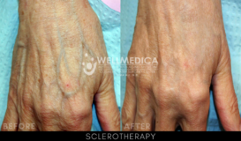Sclerotherapy - Hands