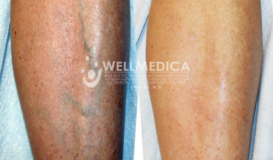 Sclerotherapy - Legs