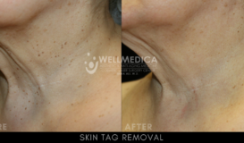 Skin Tag Removal