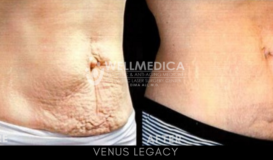Venus Legacy - Abs 2