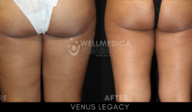 Venus Legacy - Back View Thighs