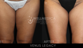 Venus Legacy - Front View Thighs