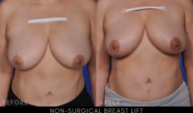 Non-Surgical Breast Lift 2