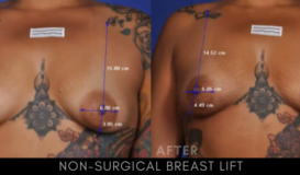 Non-Surgical Breast Lift 3