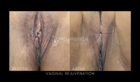 Vaginal Rejuveantion (b)