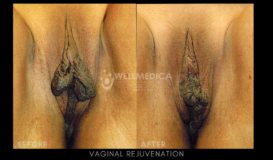 Vaginal Rejuvenation (a)