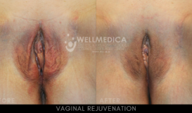 Vaginal Rejuvenation 6